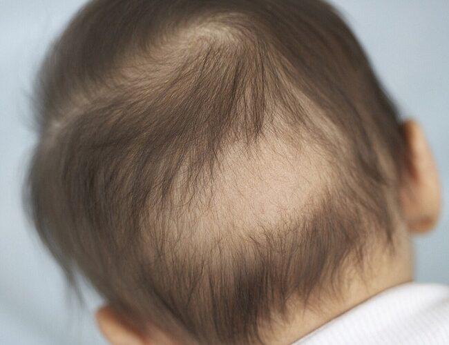 Causes of Hair Loss in Children